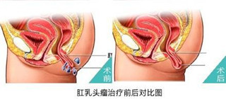 阜阳兆岐肛肠医院